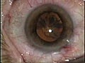 Cataract Operation