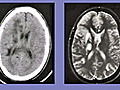 Progressive Multifocal Leukoencephalopathy