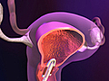 Information on Intrauterine Devices