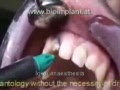 SENSATIONAL: IMPLANT WITHOUT DRILLING AND ABSOLUTE FLAPLESS IN JUST 4 MINUTES. LIVE VIDEO !