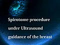 Breast Biopsy: Spirotome procedure under Ultrasound Guidance