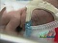 How to Reduce the Risk of Lung Damage in Preemies