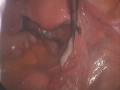 Laparoscopic Tubal Ligation with Filshie clip