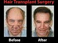 What is Surgical Hair Growth