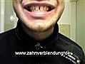 Zahnersatz Veeners Gebiss Zahnverblendung Prothese