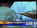 VIDEO: Boston hospital performs face transplant