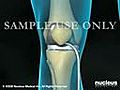 Knee Surgery