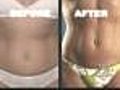 Lipo Alternative Puts Fat In More Flattering Areas