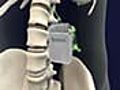 Suffering from Leg and Back Pain