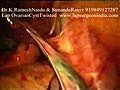 Laparoscopy Twisted Ovarian Cyst Video (Lap Ovary Cyst)