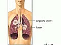 Cancer Facts : How Does Lung Cancer Develop?