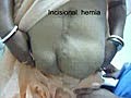 Incisional Hernia