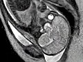 MRI Captures Baby’s Birth