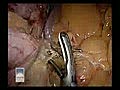 Lap Sleeve Gastrectomy