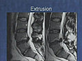 Evidence-Based Management of Common Lumbar Spine Conditions