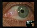 Harvard Eye Associates Pterygium