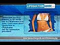 Liposuction Oklahoma