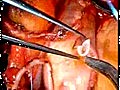 Beating Heart Surgery T Graft