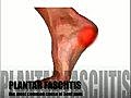 Causes and Treatments,  Plantar Facitis
