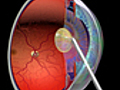 What Is Cataract Surgery?