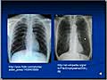 Chest X-Ray Interpretation - COPD and Emphysema