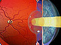 Glaucoma and the Eye