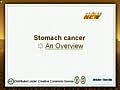 Stomach Cancer