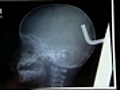 North Carolina toddler survives metal rod in head