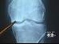 Seen At 11: Calcium Supplements