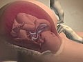 Understanding Cesarean Birth