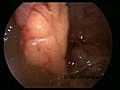 Laparoscopy Port Site Bleeding