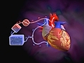 What Is Heart Bypass Surgery?