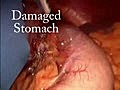 Mini Gastric ByPass after Lap Band Removal