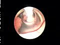 Brain Tumor ( Cyst) Endoscope