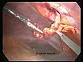 Epigastric Hernia Repair Laparoscopically