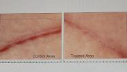 Doctors develop elastic sheet to reduce scars