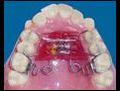Ortodontide hangi tip dis telleri kullanilir?