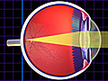 Are You Nearsighted or Farsighted?