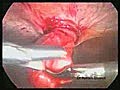 Epigastric Hernia Surgery