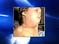 VIDEO: Mumps outbreak in Lakewood,  N.J.