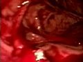Clipping in Endoscopic Stomach Surgery: Hemostasis