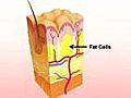 Cellulite Explained