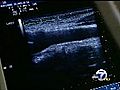 New device can spot blocked arteries