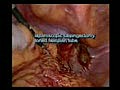 Laparoscopic Salpengectomy of a torted Fallopian Tube