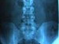 Relieving Back Pain Without Spinal Fusion