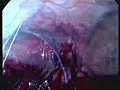 Laparoscopic Varicocelectomy