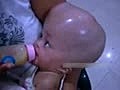 Hydrocephalus