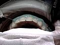 [Video] A painful price for a whiter smile?