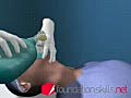 EndotracheaI Intubation During General Anaesthesia