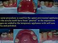 Lecture 10 - Rotational path partial dentures,  Dental Prosthodontics